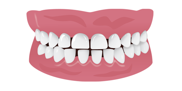 Diastema