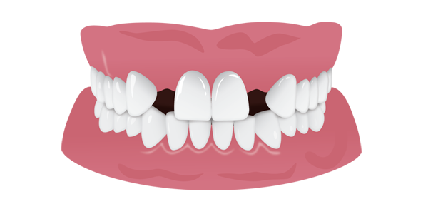 Mordida com espaço extra