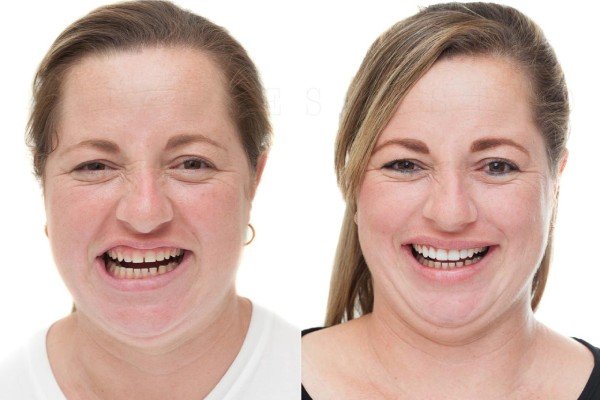 Paciente antes e depois de lentes de contato dental em porcelana. Realizado na Freitas Odontologia em Campinas