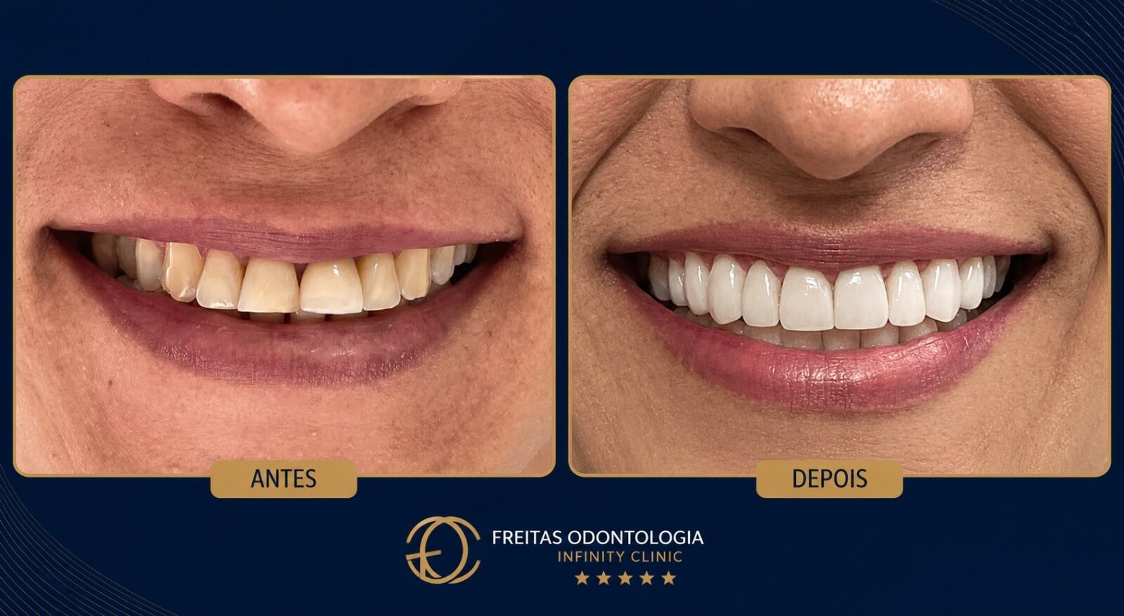 Lentes de Contato Dental Antes e Depois (1)